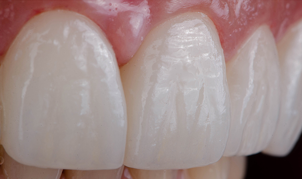 Hochwertiger Zahnersatz